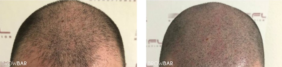 What is Scalp Micropigmentation