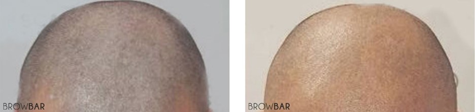 Scalp Micropigmentation vs Tattoo
