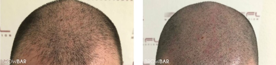 hair transplant vs scalp micropigmentation