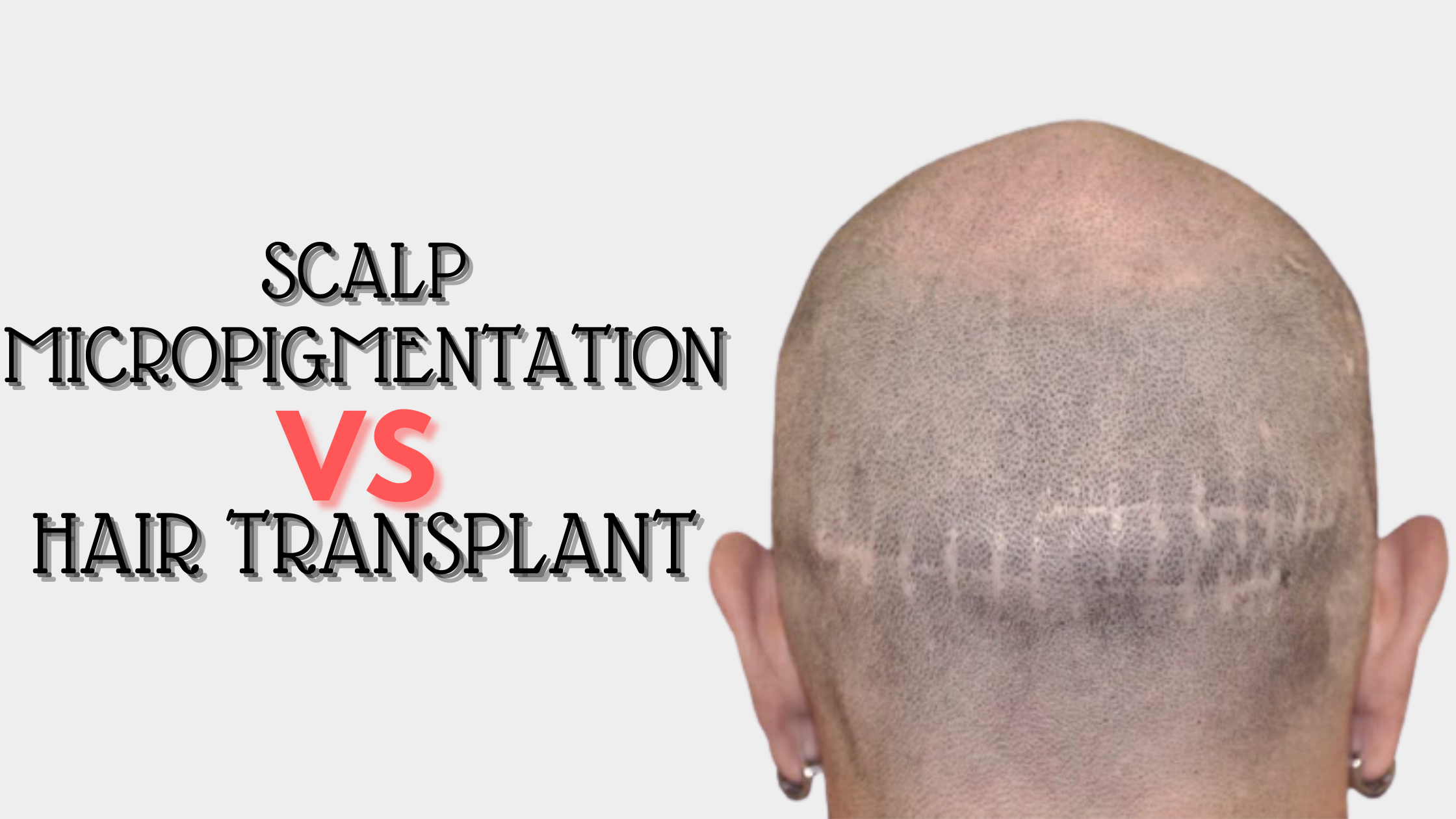 Hair Transplant vs Scalp Micropigmentation