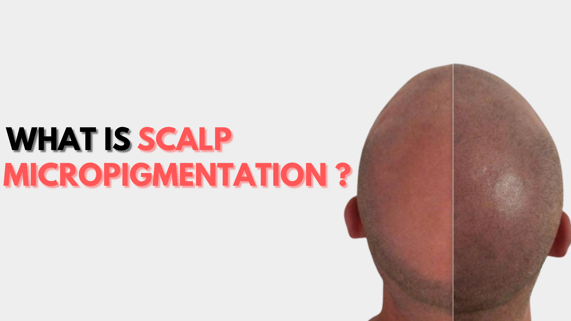 WHAT IS SCALP MICROPIGMENTATION